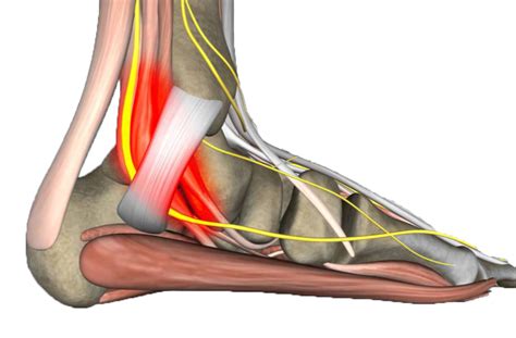 Tarsal Tunnel Syndrome Archives Obrien Medical