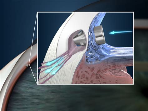 Cirugía Minimamente Invasiva de Glaucoma MIGS Fernández Casas