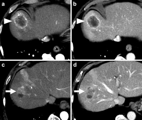 Contrast Enhanced Ct Before Hepatectomy A B The Low Density Area