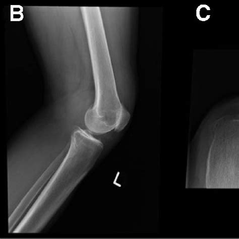 A Native Patella Before Osteophyte Resection B Patella With