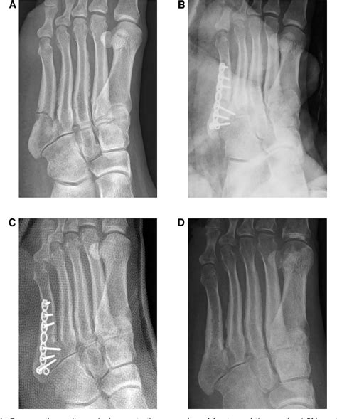 Figure 2 From Plate Fixation Of Proximal Fifth Metatarsal Fracture Semantic Scholar