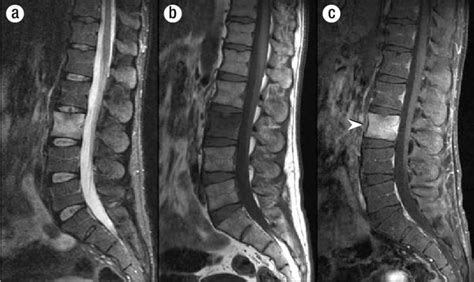 Sagittal Mri Of The Lumbar Spine Reveals Abnormalities Of The L3