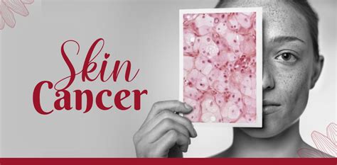 Skin Cancer Types Causes And Treatment Dr Priya Tiwari