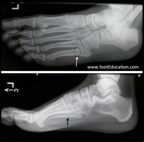 Metatarsal Fractures Orthopaedia Foot And Ankle