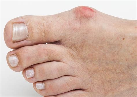What Are The Most Common Causes Of Big Toe Pain