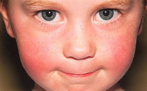 Sebagian penyebab dari ruam merah pada kulit orang dewasa bisa terjadi akibat dari; Penyebab Kemerahan di Kulit dan Cara Mengatasinya ...