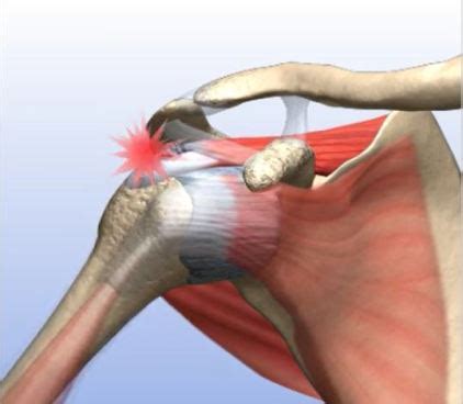 If your rotator cuff is injured, you may need surgery to repair it. Understanding Partially Torn Rotator Cuff Repair - Sports ...