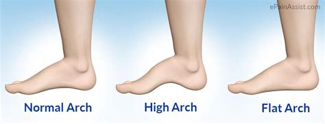 High Arch Foot Overview And Characteristics Ideastep