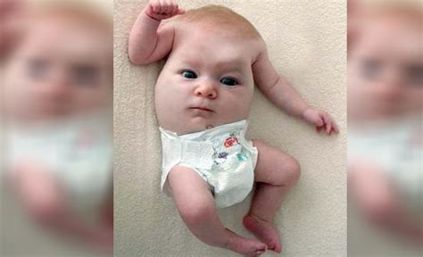 Baby Born With Face On Torso And No Head Might Be ‘creepiest Ever