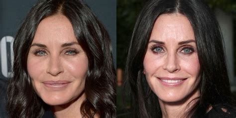 Plastic Surgery Before And After 9 Celebrities On What Its Really Like