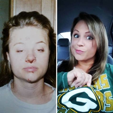 How Drug Addiction Looks Before And After Pics Izispicy Com