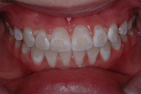 Teeth Have White Spots What Can Be Done Mcomie Dentistry