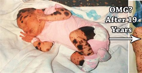 This Teenager Was Bullied Because Of Her Hundred Birthmarks But Shes