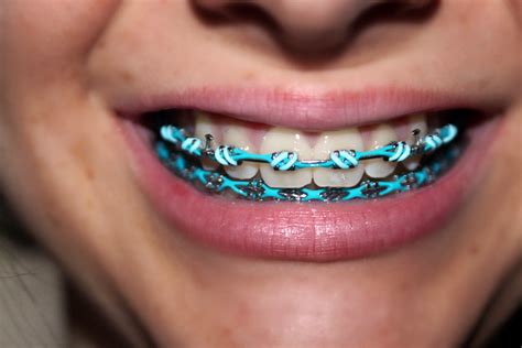 Braces 10 Teal And Light Blue Flickr Photo Sharing