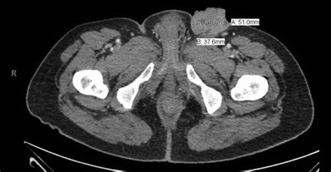 Elderly Man With Weight Loss And Groin Masses Annals Of Emergency