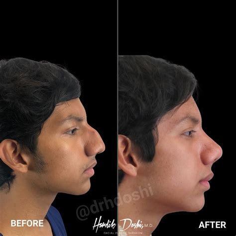 Nose Job Before And After Men