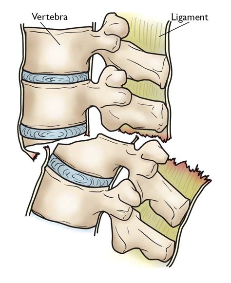 Fractures Of The Thoracic And Lumbar Spine Orthoinfo Aaos