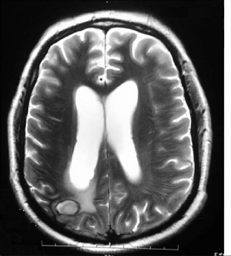 Magnetic Resonance Imaging Brain Showing Evolving Abscess With Areas Of