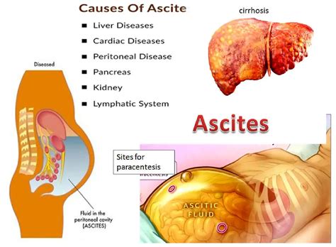 Ascites Cause Grades Symptoms Diagnosis And Treatment Of Cirrhotic Ascites Science Online