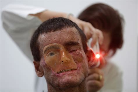 Brazilian Villagers Suffer From Rare Skin Disease That Worsens In