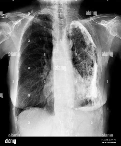 Pulmonary Tuberculosis X Ray Of The Lungs Of An 80 Year Old Woman