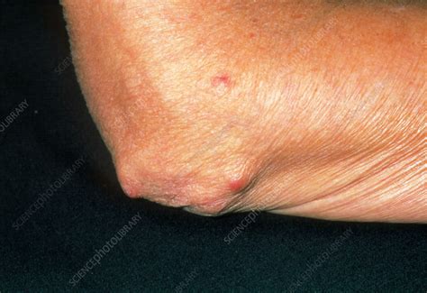 Rheumatoid Arthritis Nodules Stock Image M110 0473 Science Photo