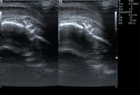 Penile B Mode Sonography Revealed A Calcified Peyronie Plaque