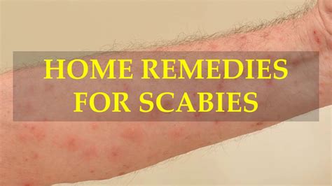 Home Remedies For Scabies Youtube