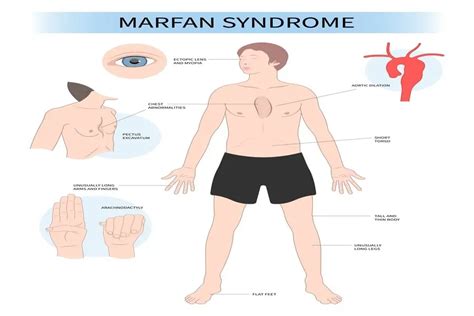 Marfan Syndrome Understanding The Genetic Disorder Longmore Clinic