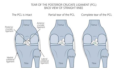 Pcl Injury Posterior Cruciate Ligament Orthopedic Knee Specialist