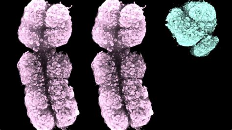 Developing A New Tool To Detect A Frequently Missed Sex Chromosome