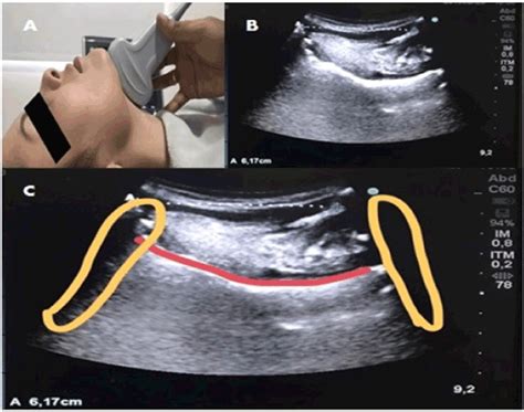 Development Of Ultrasound Diagnostic Test For Preoperative Airway