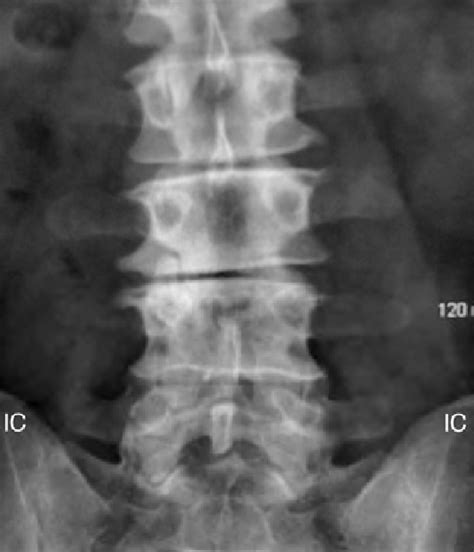 Normal Ap Lumbar Spine X Ray