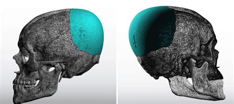 Plastic Surgery Case Study Custom Skull Implant For Occipital