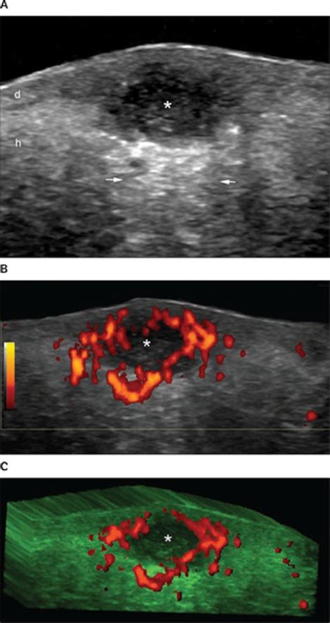 Sonography Of Acne Vulgaris Wortsman 2014 Journal Of Ultrasound