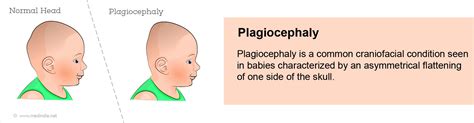 Plagiocephaly Types Causes Symptoms Complications Diagnosis