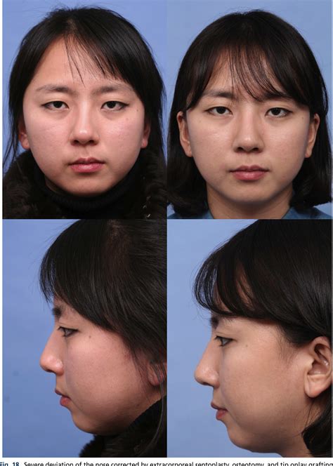 Figure 18 From Rhinoplasty In The Asian Nose Semantic Scholar