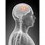 Greyscale Picture Of Person With Brain And Tumor Highlighted  NFCR