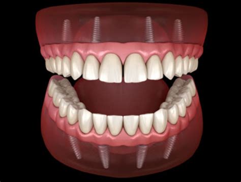 What You Need To Know About All On Four Dental Implants Guide