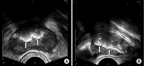 Transrectal Ultrasonography A Transverse View B Sagittal View