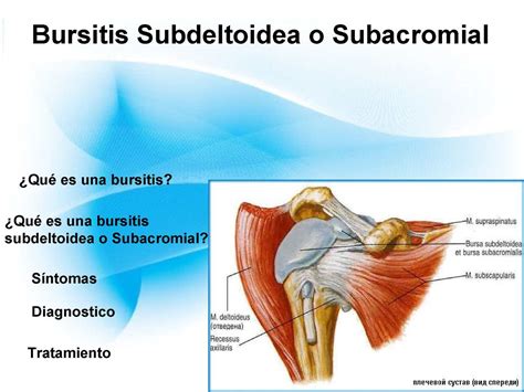 Caso Clinico Bursitis Subacromial Subdeltoidea My Xxx Hot Girl