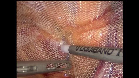 Laparoscopic Inguinal Hernia Repair Tapp Mesh Fixation By Liquiband