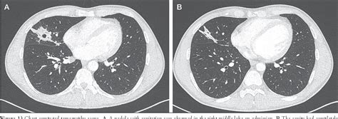 Figure 1 From Actinomyces Graevenitzii Pulmonary Abscess Mimicking