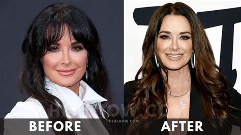 kyle richards weight loss [2024] before and after