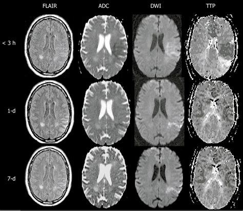 Magnetic Resonance Diffusion Perfusion Mismatch In Acute Ischemic