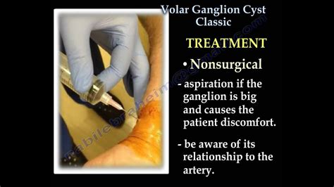 Volar Ganglion Cyst Classic Everything You Need To Know Dr Nabil Ebraheim Youtube