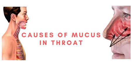 Causes Of Mucus In Throat Mucus In Throat Mucus Phlegm In Throat