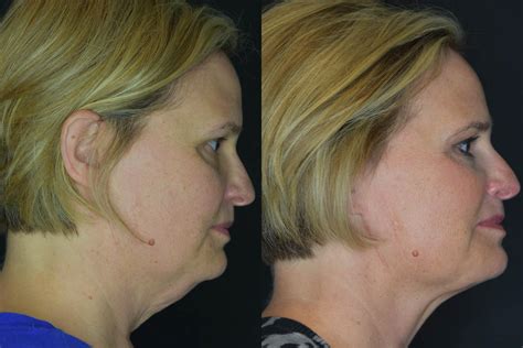 Kybella Before And After 01 Bella Vi