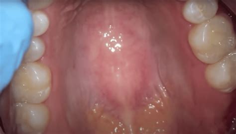 Developing a bump on the roof of mouth is a problem that at least a large number of people have experienced. If You Have Hard Bumps On The Roof Of Your Mouth, This Is ...
