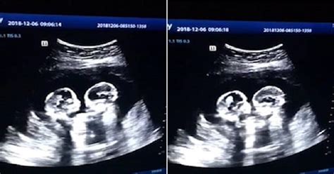Routine Ultrasound Scan Revealed Identical Twin Sisters Fighting In